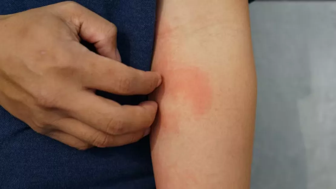 Dermatite atopique : de nouveaux traitements pour vivre "sans symptomes" avec son eczéma
